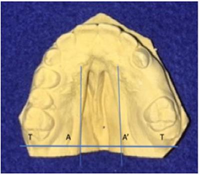 Maternal Smoking Leads to Larger Cleft Palate Defects